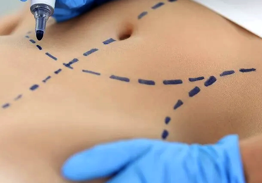 Body Contouring
