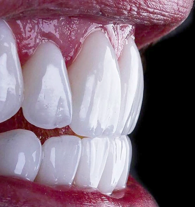 E-Max Crowns