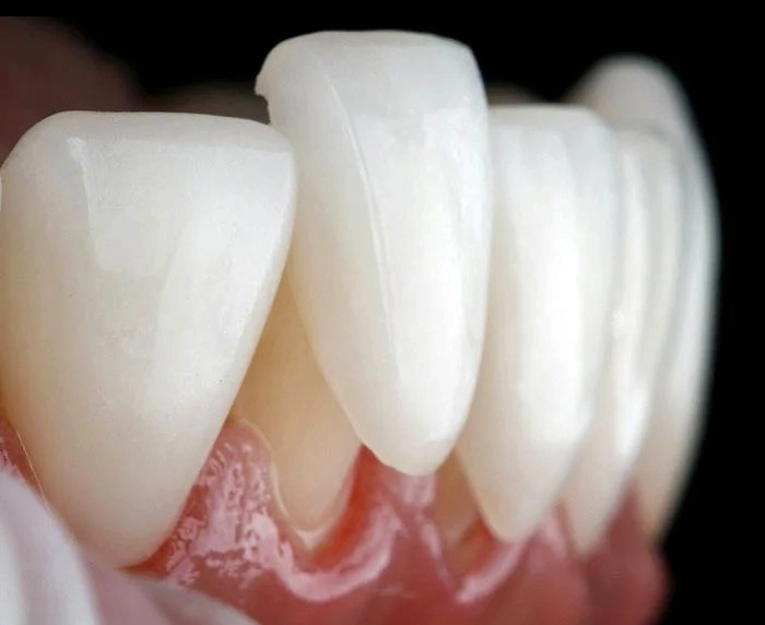 E-Max Laminate Veneers