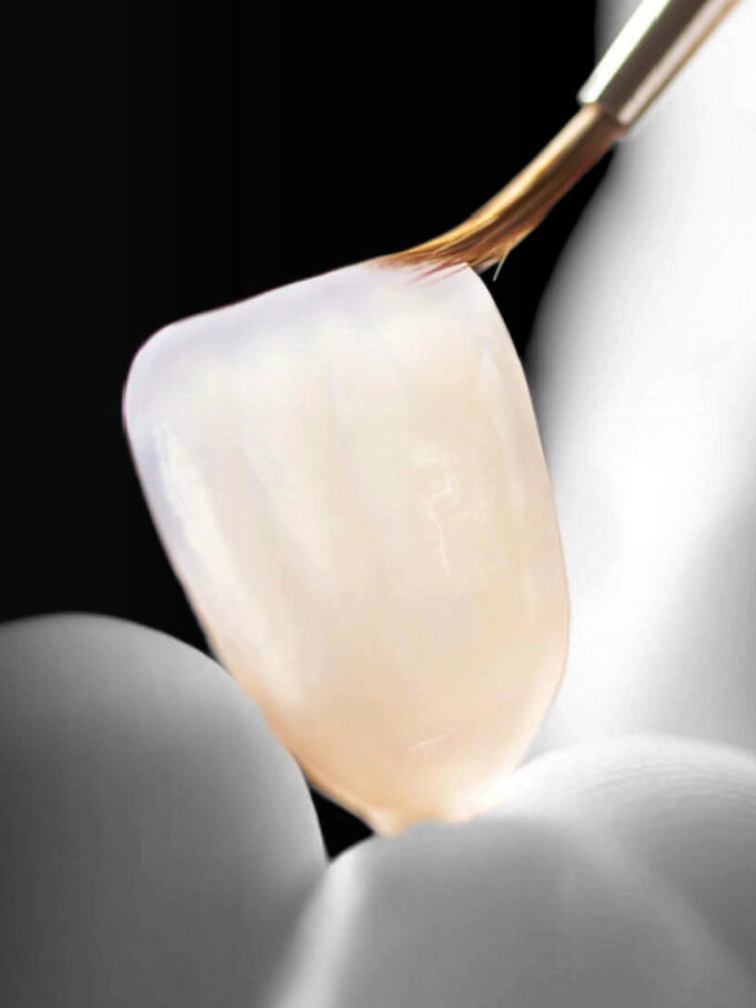 E-Max Veneers Process