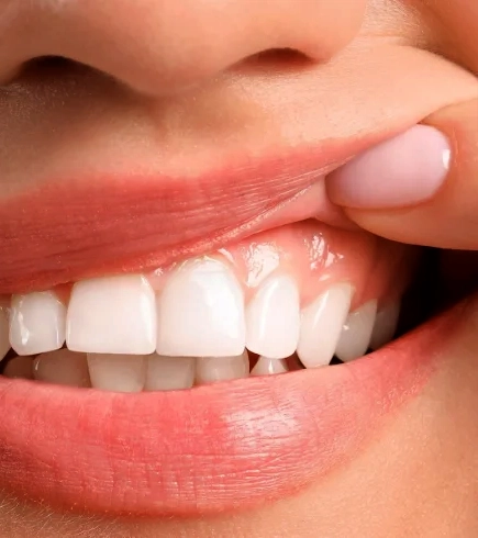 Gummy Smile Case