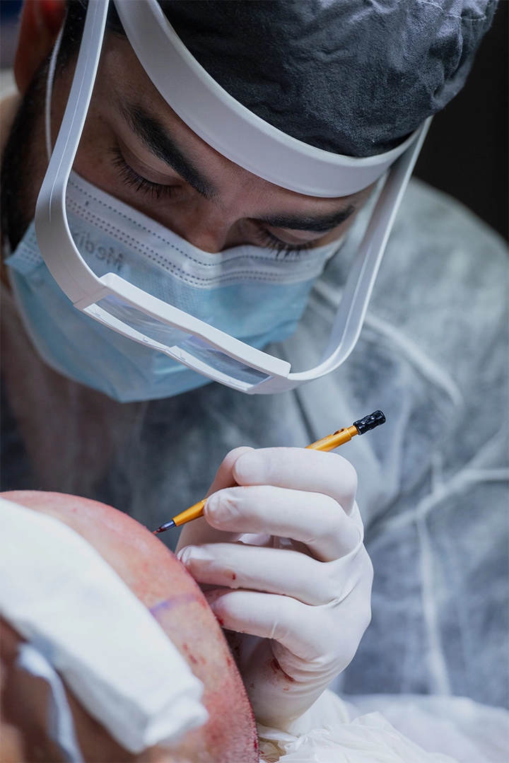 Hair Transplant Background