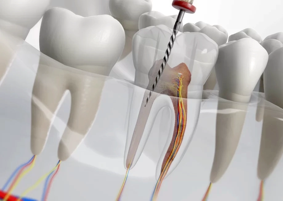 Root Canal Treatment