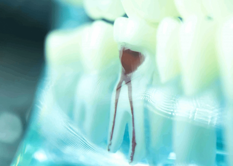 Endodontic Precision