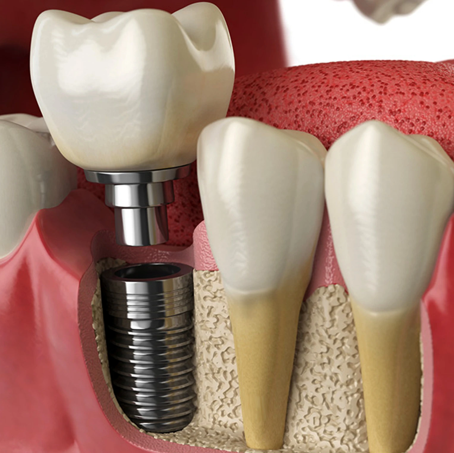 Dental Implant